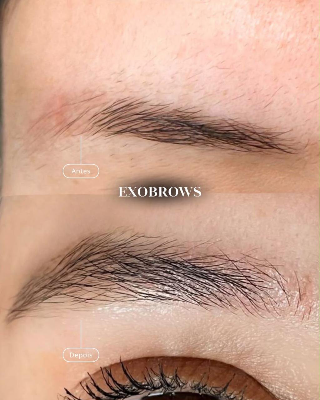 Resultado antes e depois de sobrancelha com exossomos na AMMO